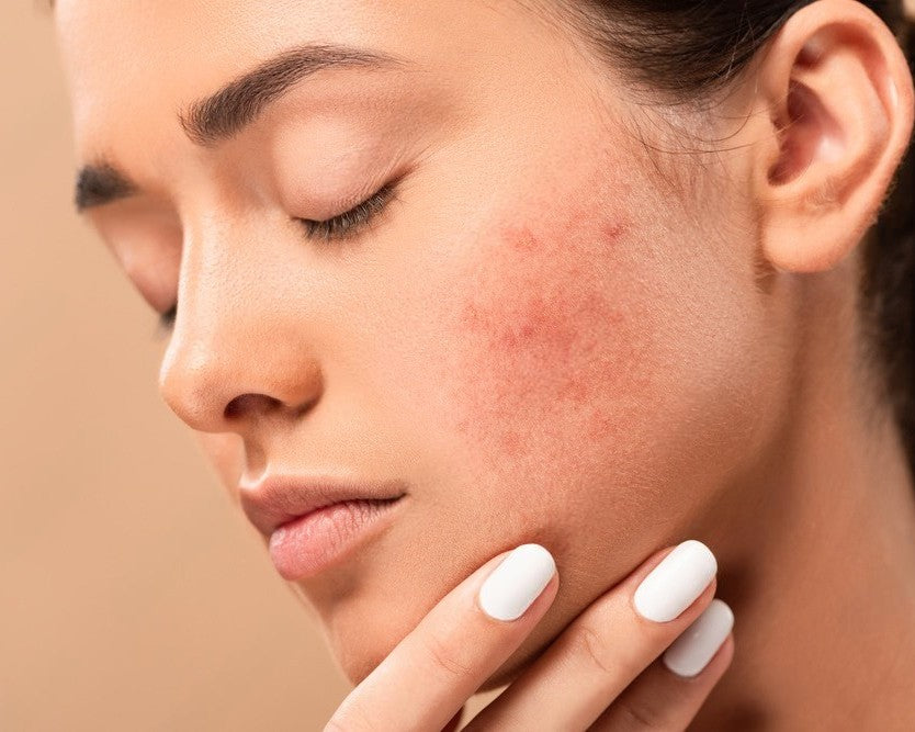 Hormonal Acne 101: The Complete 2026 Guide to Causes, Triggers & Real Solutions