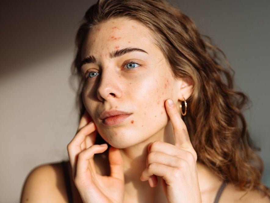 How to Get Rid of Dark Spots: The 2026 Hyperpigmentation Routine That Actually Works - Everbeaut